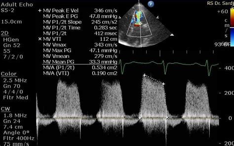 severe mitral stenosis mva